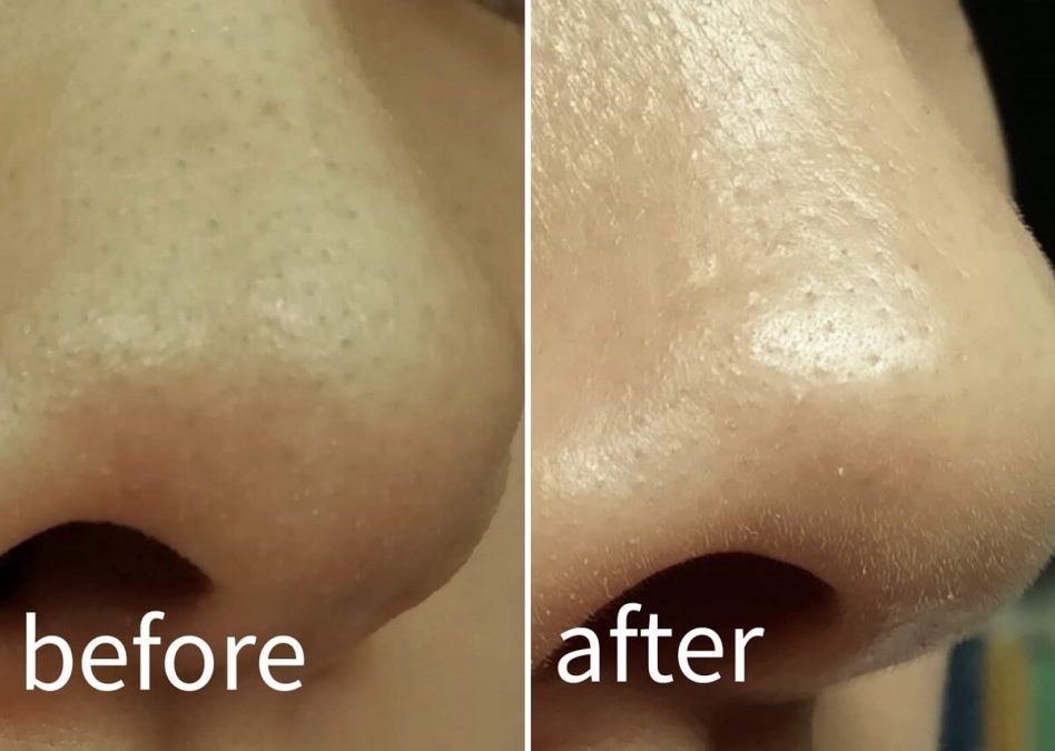 鼻の毛穴と角栓の改善