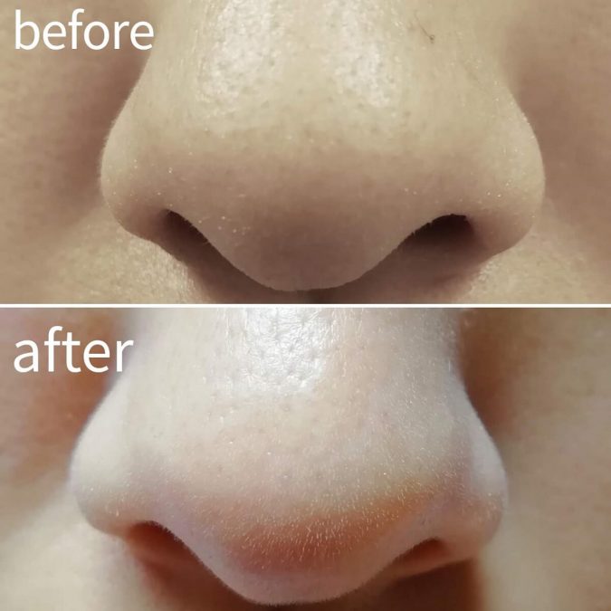 鼻の毛穴黒ずみ改善